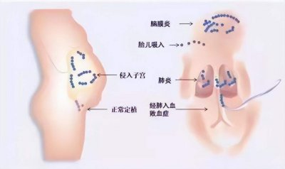 ​孕晚期的GBS检查是什么？准妈妈们可别忘了做哦